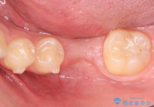 インプラント治療とインビザライン矯正治療 総合歯科治療の治療前