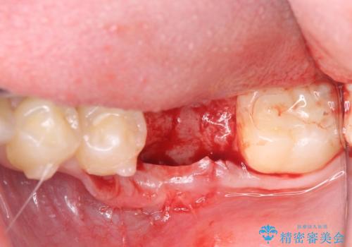 インプラント治療とインビザライン矯正治療 総合歯科治療の治療中