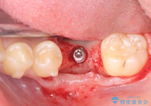 インプラント治療とインビザライン矯正治療 総合歯科治療の治療後