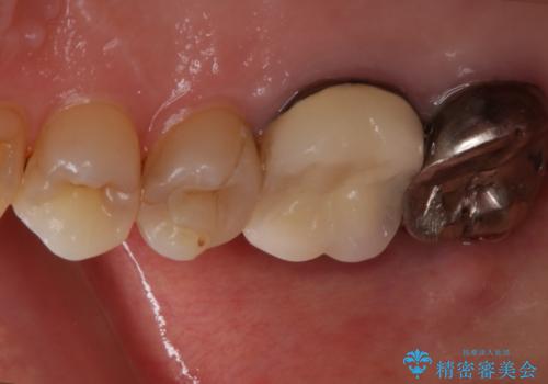 歯ぐきにニキビのようなものができた:原因から改善、被せ物までの治療前