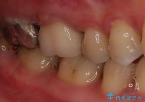 歯ぐきにニキビのようなものができた:原因から改善、被せ物までの治療前