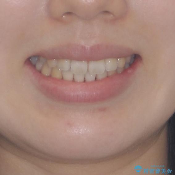気になる前歯をインビザラインで綺麗にの治療後(顔貌)