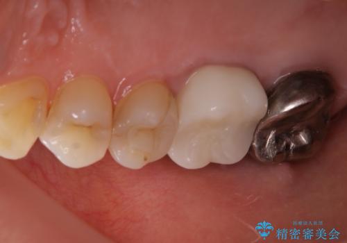 歯ぐきにニキビのようなものができた:原因から改善、被せ物までの治療後