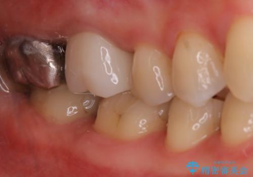 歯ぐきにニキビのようなものができた:原因から改善、被せ物までの治療後