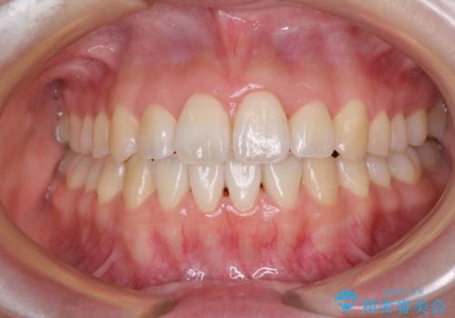 気になる前歯をインビザラインで綺麗にの治療後