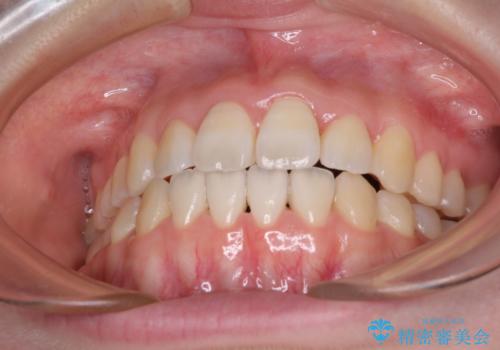 気になる前歯をインビザラインで綺麗にの治療後