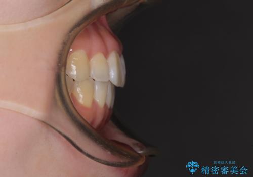 気になる前歯をインビザラインで綺麗にの治療後
