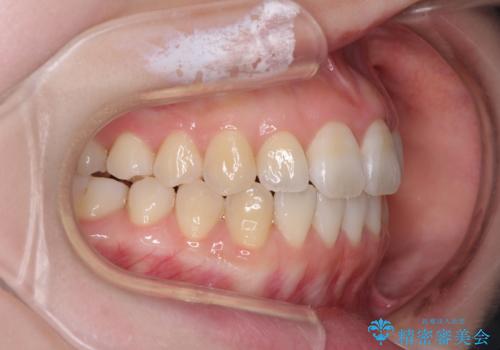 気になる前歯をインビザラインで綺麗にの治療後