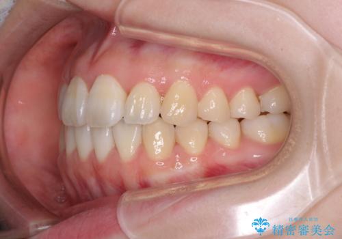 気になる前歯をインビザラインで綺麗にの治療後