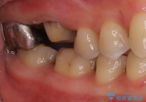 歯ぐきにニキビのようなものができた:原因から改善、被せ物までの治療中