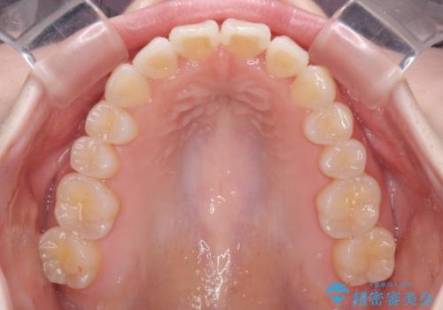 気になる前歯をインビザラインで綺麗にの治療後