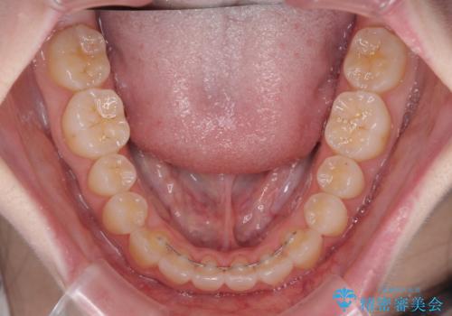 気になる前歯をインビザラインで綺麗にの治療後