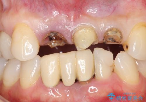 前歯のブリッジ　オールセラミッククラウン　歯根が割れてしまった歯の治療の治療前
