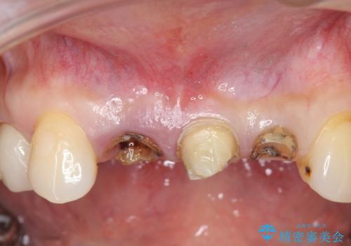 前歯のブリッジ　オールセラミッククラウン　歯根が割れてしまった歯の治療の治療前