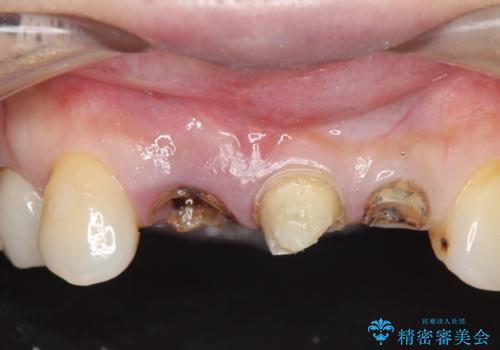 前歯のブリッジ オールセラミッククラウン 歯根が割れてしまった歯の治療の治療前