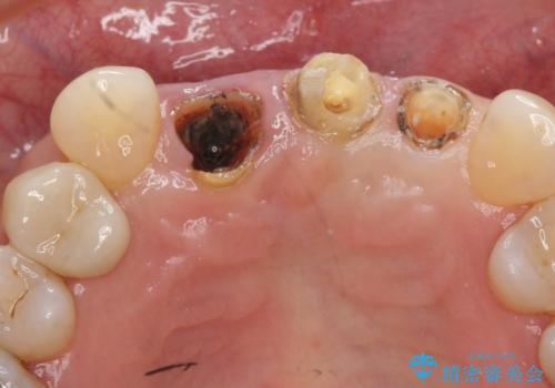 前歯のブリッジ オールセラミッククラウン 歯根が割れてしまった歯の治療の治療前