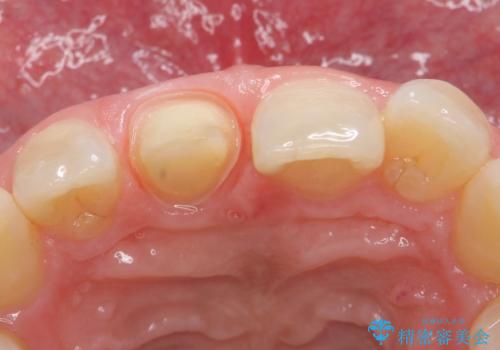 オールセラミッククラウン 痛みの引かない歯の治療の治療中