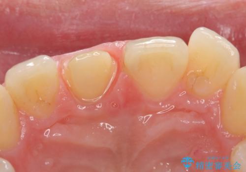 オールセラミッククラウン 痛みの引かない歯の治療の治療中