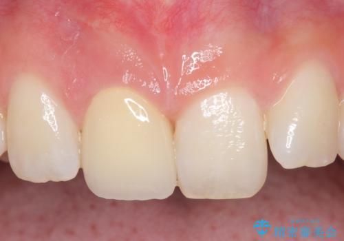 オールセラミッククラウン 痛みの引かない歯の治療の症例 治療後