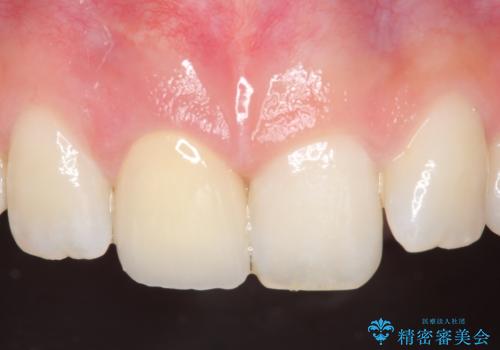 オールセラミッククラウン 痛みの引かない歯の治療の治療後