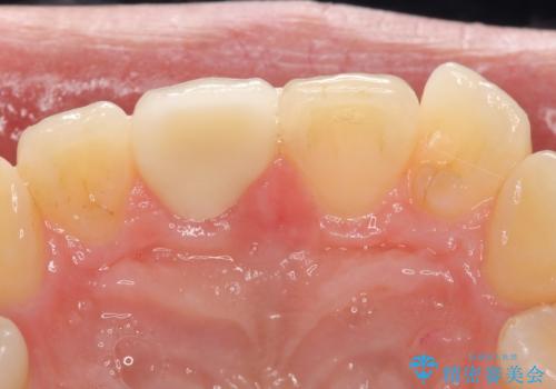 オールセラミッククラウン 痛みの引かない歯の治療の治療後