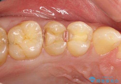 虫歯をなおしたい、セラミックインレー修復の治療中