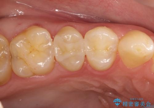 虫歯をなおしたい、セラミックインレー修復の症例 治療後