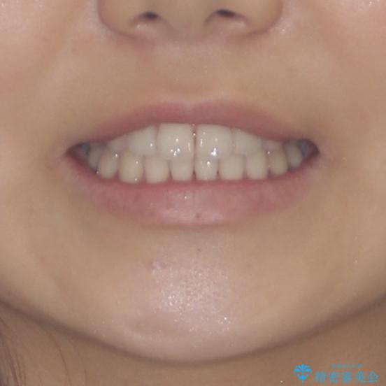 気になる前歯を整えたい　インビザライン・ライトでの矯正治療の治療後（顔貌）