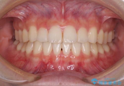 気になる前歯を整えたい インビザライン・ライトでの矯正治療の治療後