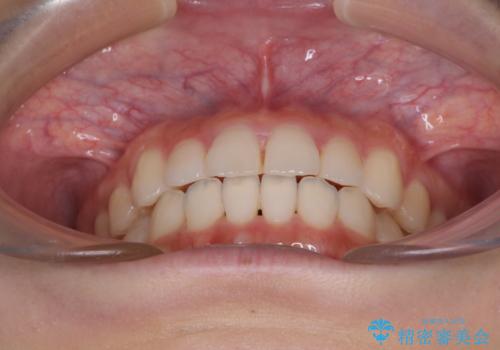 気になる前歯を整えたい インビザライン・ライトでの矯正治療の治療後