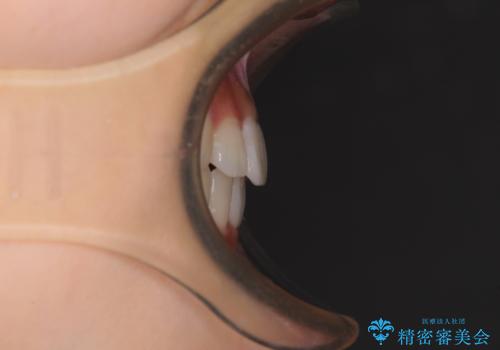 気になる前歯を整えたい インビザライン・ライトでの矯正治療の治療後