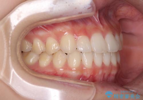 気になる前歯を整えたい インビザライン・ライトでの矯正治療の治療後