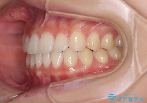 気になる前歯を整えたい インビザライン・ライトでの矯正治療の治療後