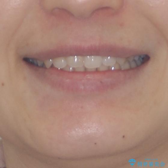 奥歯の倒れた歯を改善　インビザラインでの矯正治療の治療後（顔貌）