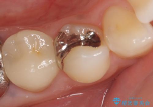 PGA(ゴールド)インレー 甘いものがしみる歯の治療の治療前