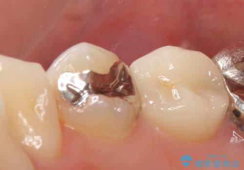 PGA(ゴールド)インレー 甘いものがしみる歯の治療の症例 治療前