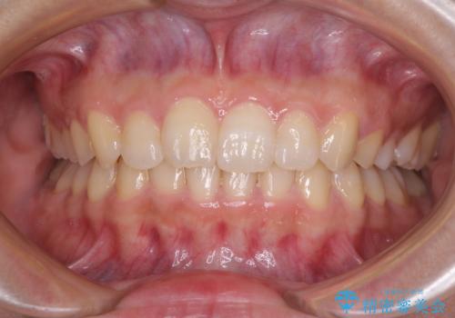 奥歯の倒れた歯を改善　インビザラインでの矯正治療の症例 治療後