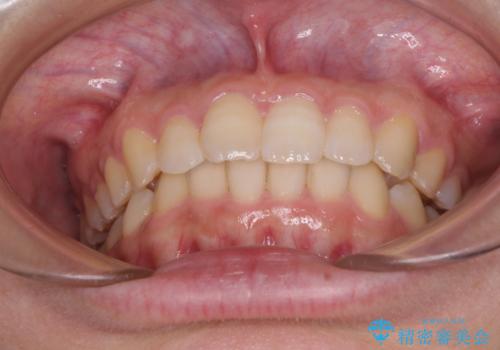 奥歯の倒れた歯を改善 インビザラインでの矯正治療の治療後