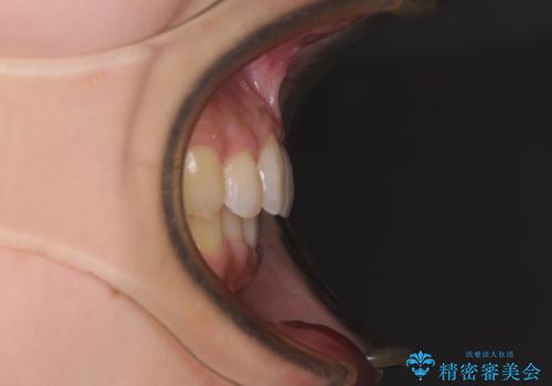 奥歯の倒れた歯を改善 インビザラインでの矯正治療の治療後