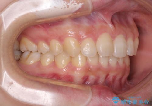 奥歯の倒れた歯を改善　インビザラインでの矯正治療の治療後