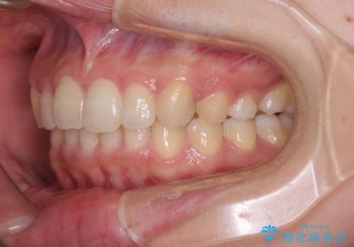 奥歯の倒れた歯を改善 インビザラインでの矯正治療の治療後