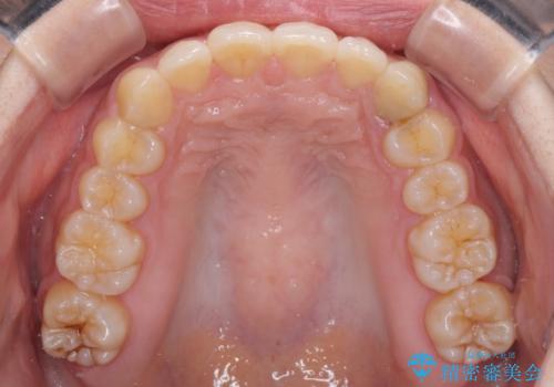 奥歯の倒れた歯を改善 インビザラインでの矯正治療の治療後