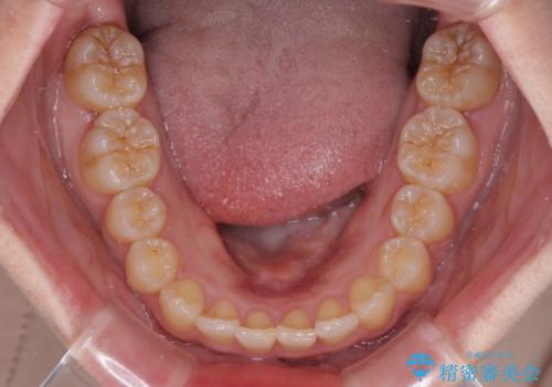 奥歯の倒れた歯を改善 インビザラインでの矯正治療の治療後