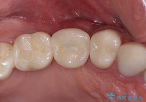 折れてしまった歯 インプラントによる補綴治療の症例 治療後