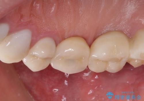 折れてしまった歯 インプラントによる補綴治療の治療後