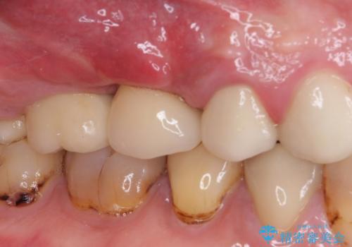 折れてしまった歯 インプラントによる補綴治療の治療後
