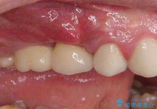 折れてしまった歯 インプラントによる補綴治療の治療後