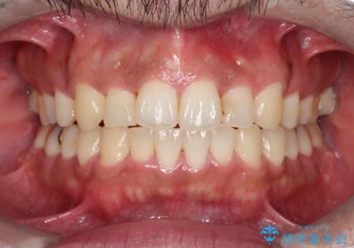 出っ歯の抜歯矯正 裏側ワイヤーによる目立たない矯正の治療後