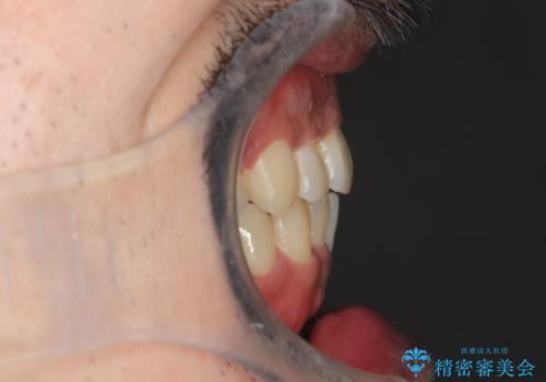 出っ歯の抜歯矯正　裏側ワイヤーによる目立たない矯正の治療後