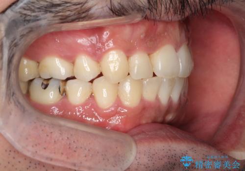 出っ歯の抜歯矯正 裏側ワイヤーによる目立たない矯正の症例 治療後